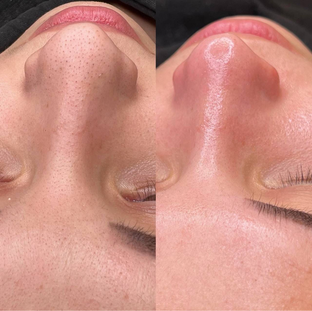 Уходовая процедура для жирной и проблемной кожей, с акне, постакне на дерматокосмецевтике ONmacabim (Израиль)