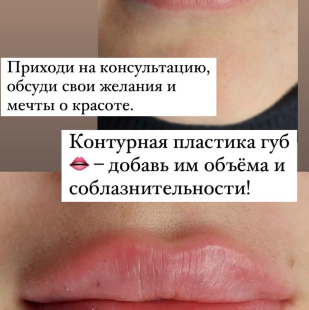 Увеличение губ с препаратом UltraLips 1.0ml