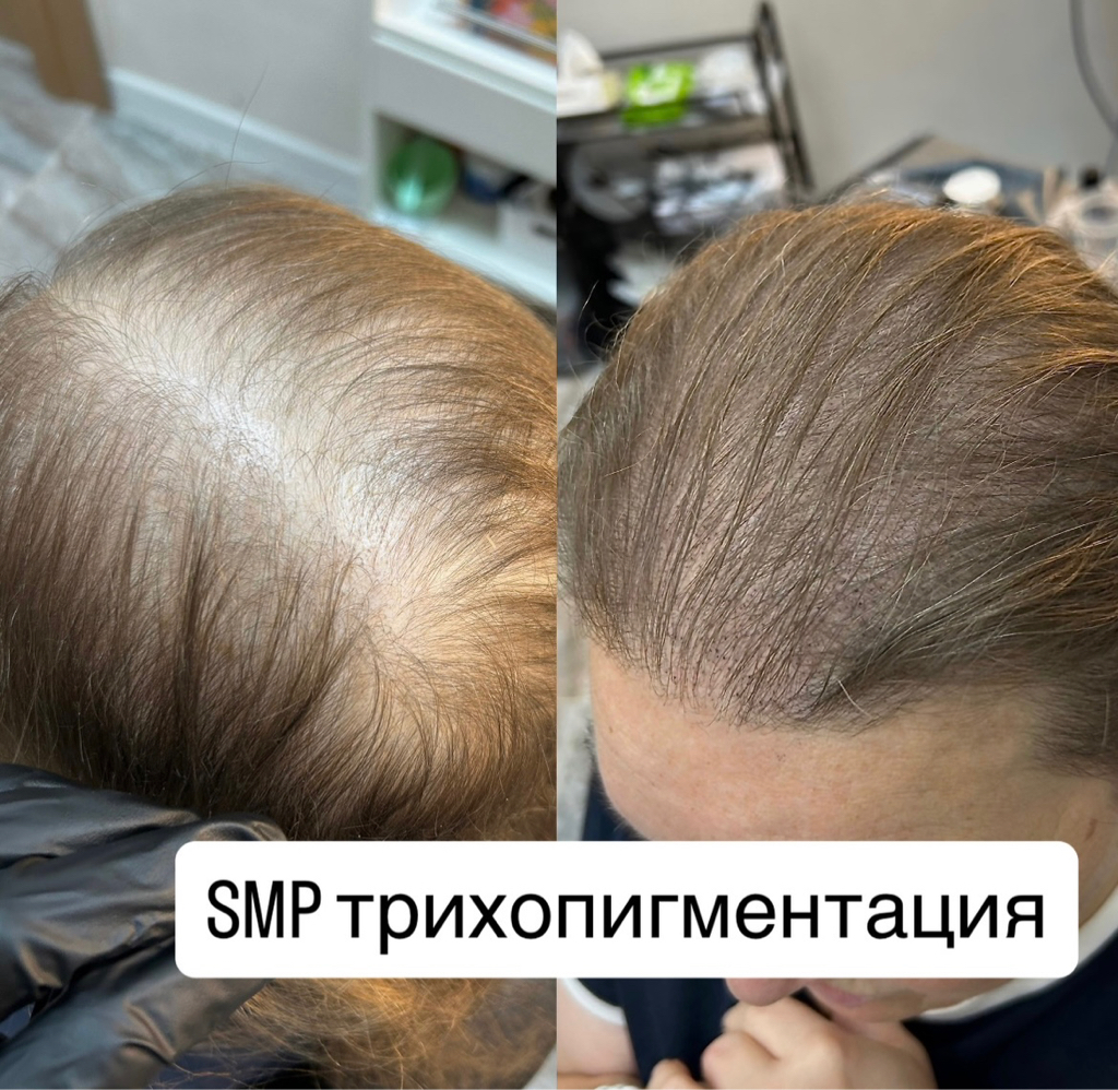 Трихопигментация, микропигментация SMP (загущение волос , закрашивание залысин )