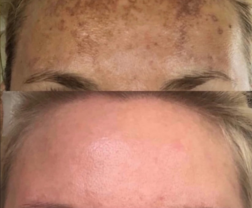 Фракционная мезотерапия + пилинг