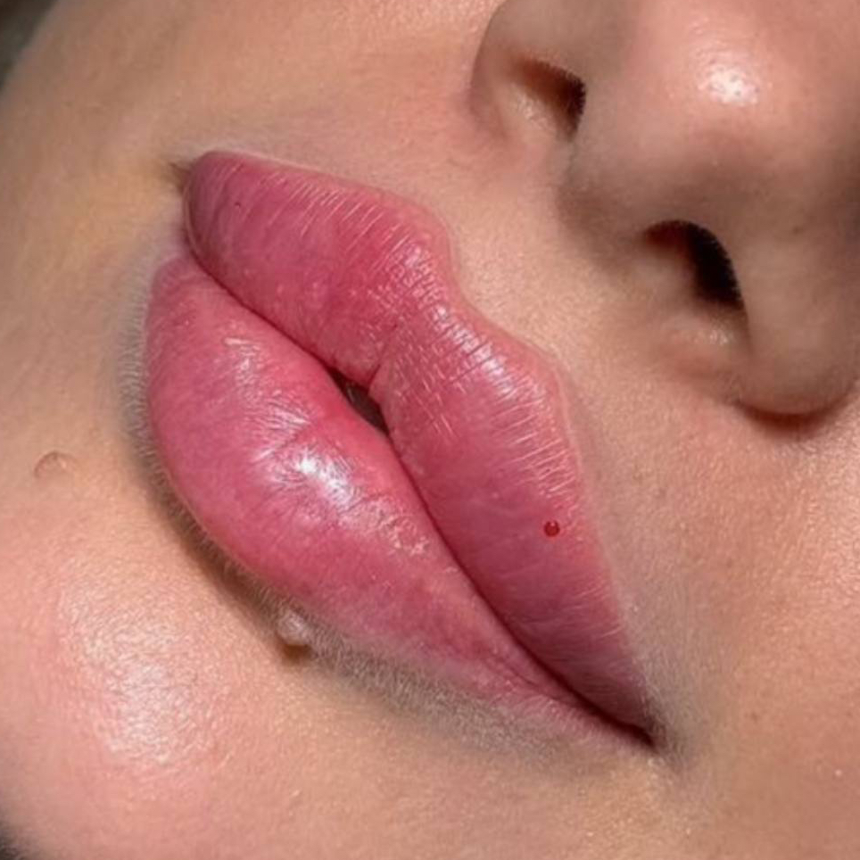 Увеличение губ