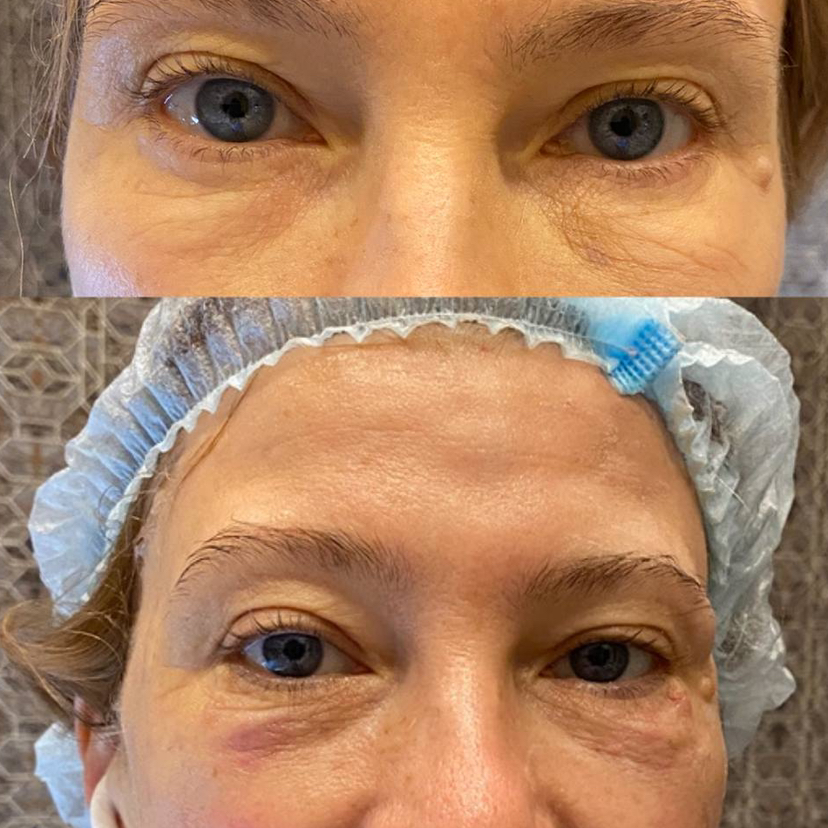 Омоложение Нитями (микропоинты) Результат надолго