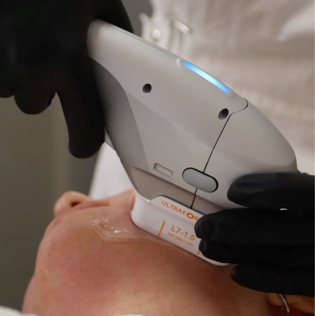 SMAS - лифтинг лицо полностью до 150 линий