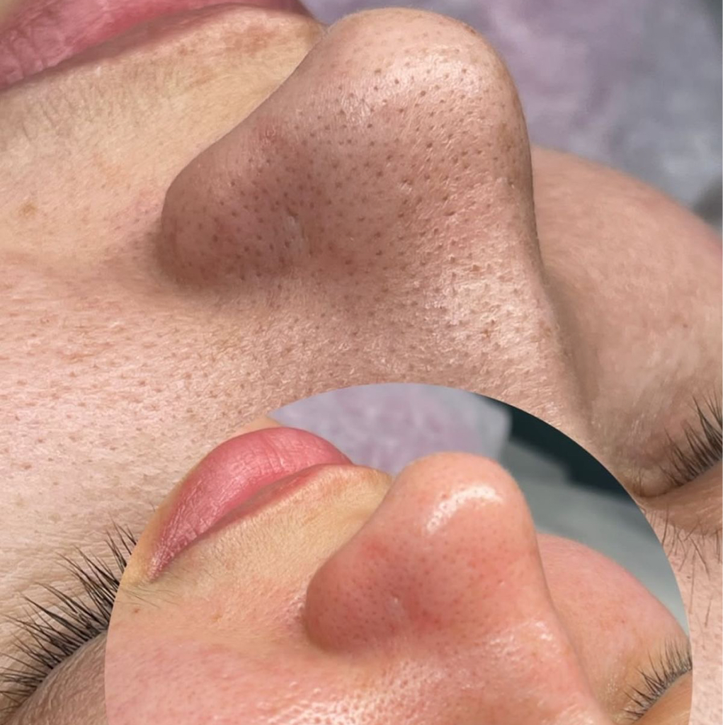 14-ти этапная УЗ-чистка с пилингом