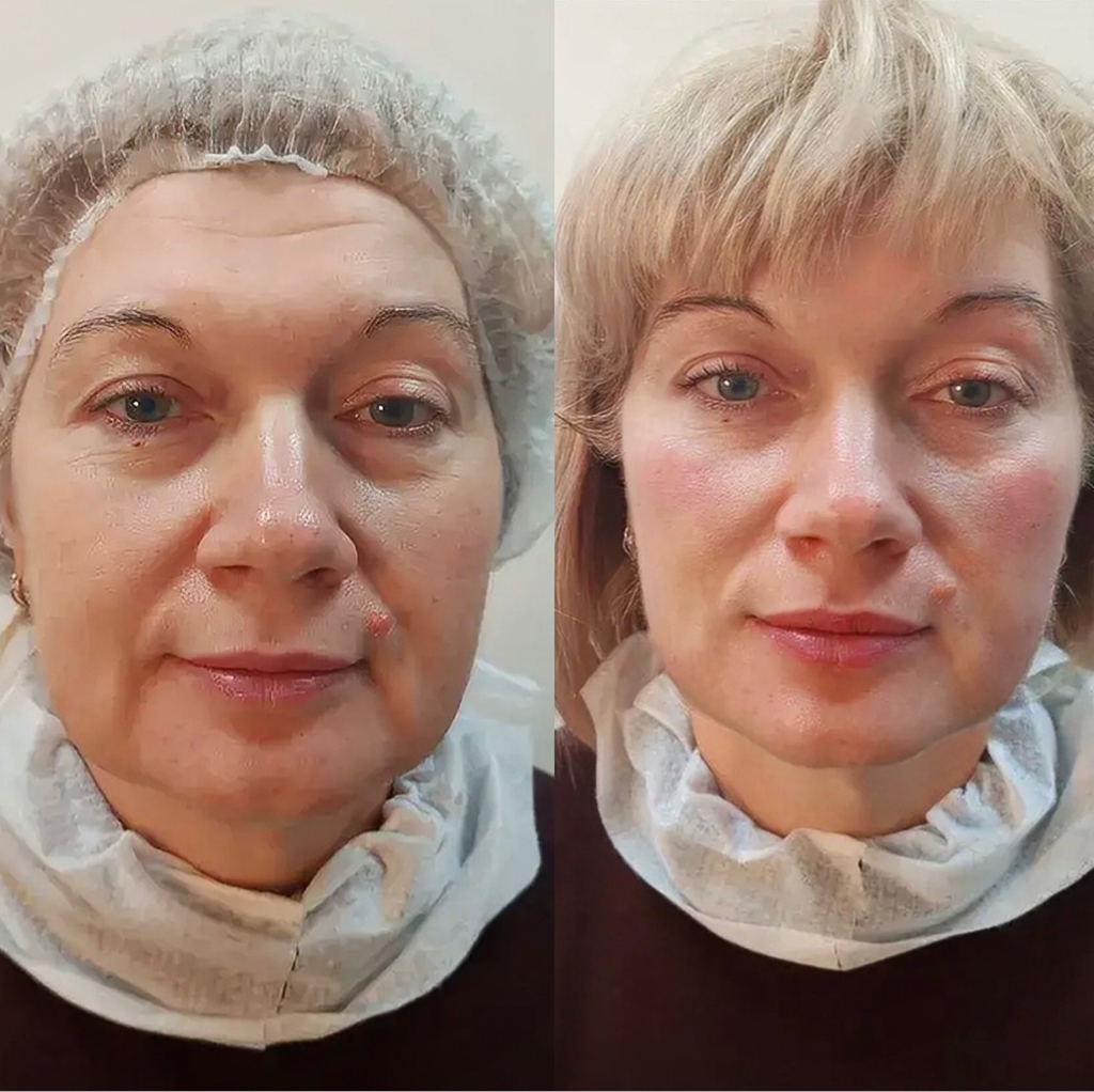 Смас лифтинг (SMAS лифтинг) вокруг глаз 150 линий