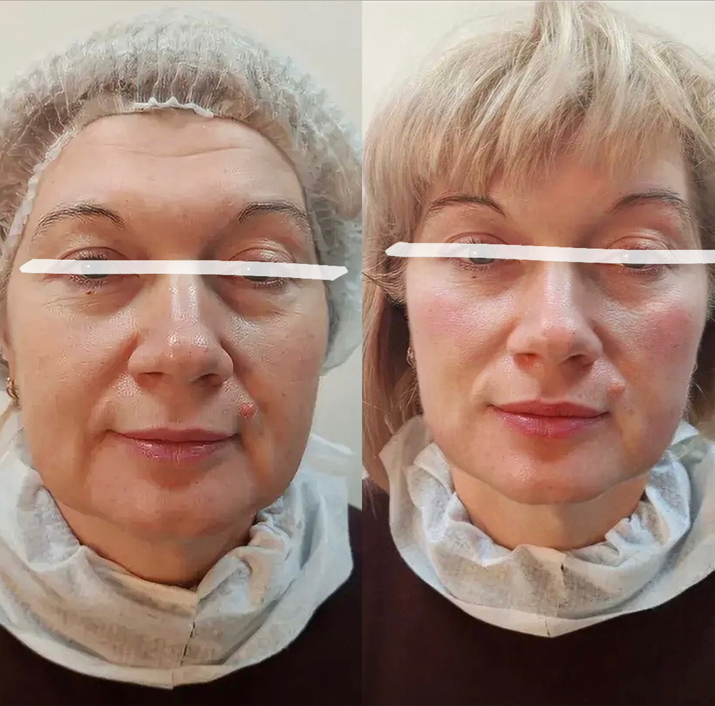 Смас лифтинг (SMAS лифтинг) лицо 10000 линий