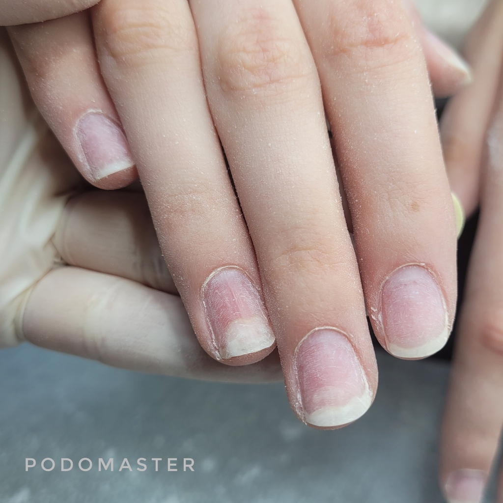 Обработка / онихолизис 1 ед.