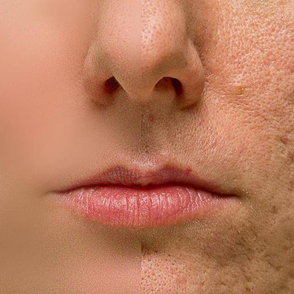 ПРОФИЛАКТИКА АКНЕ