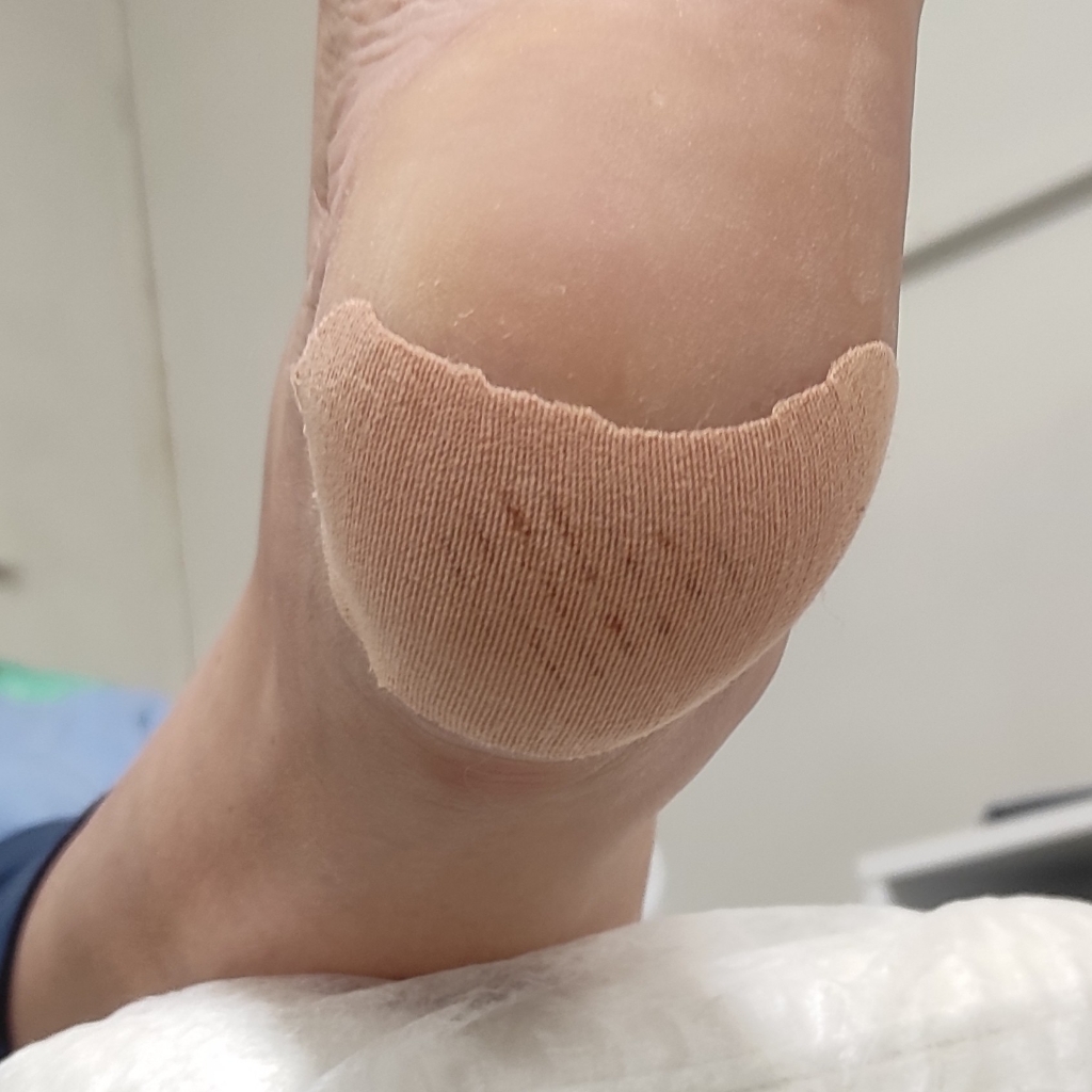 Трещины на стопе. Обработка и разгрузка.