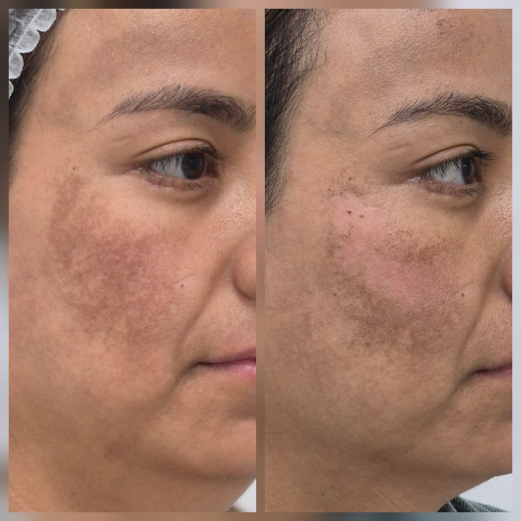 Фото коррекция пигментации