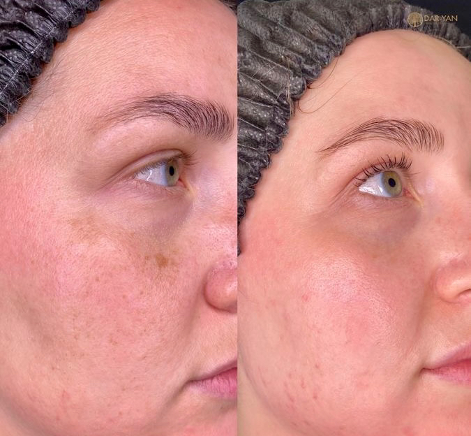 NOMELAN CAFEICO. MEDI + DERMA  (Испания). Кофейный пилинг для активации клеточного обновления и устранению пигментных пятен.