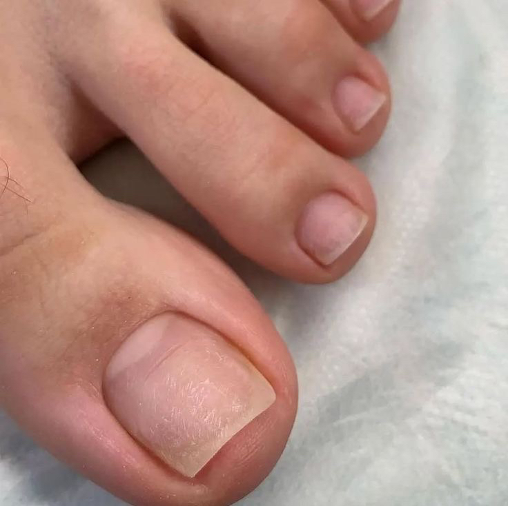 Педикюр, снятие с обработкой