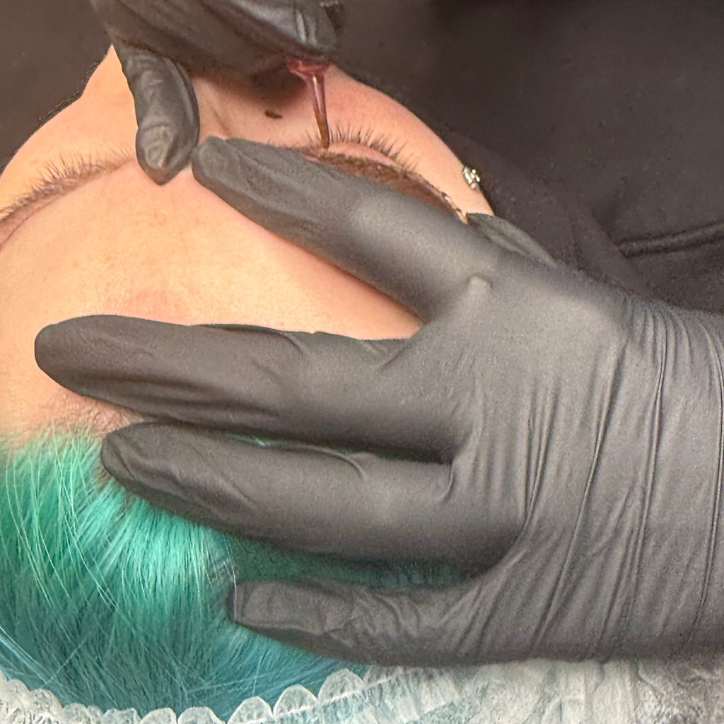 Удаление тату 1 см