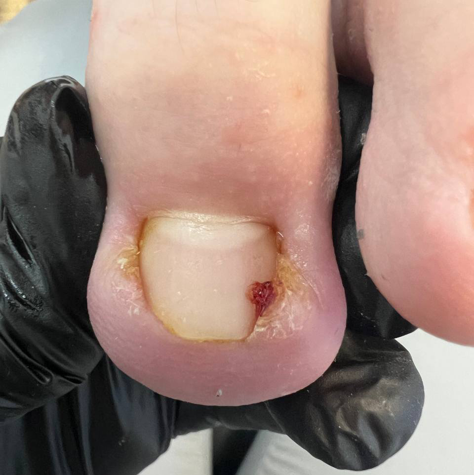 Обработка вросшего сегмента 2 степени ( обработка с 2-х сторон ногтевой пластины)