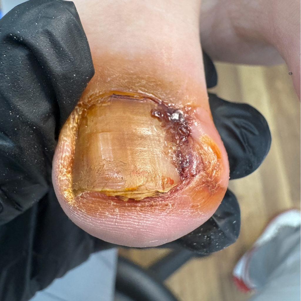 Обработка вросшего сегмента 3 степень (болезненные ощущения, выделения)