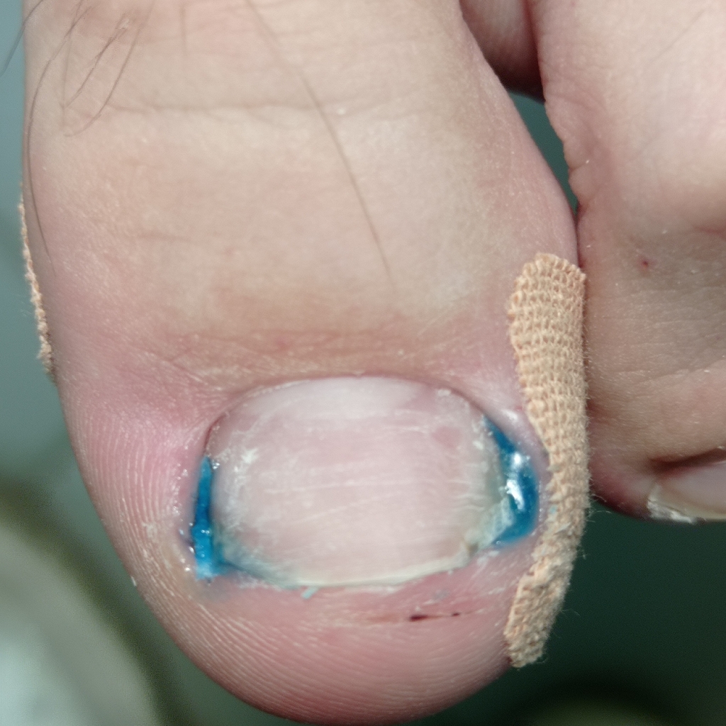 Установка тампонады (отдельно от процедуры)