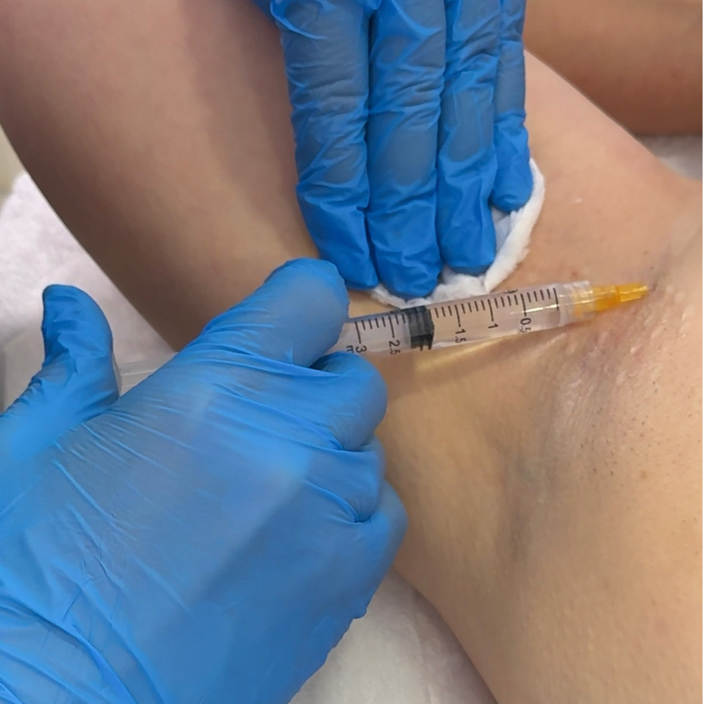 Инъекции ботокса в подмышки