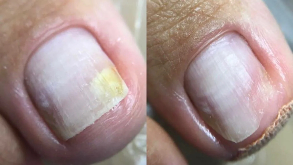 Зачистка онихолизиса