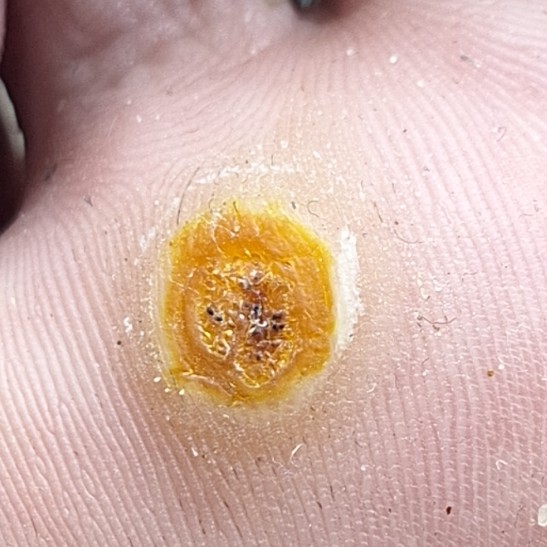 Обработка бородавки 1 ед.
повторное посещение