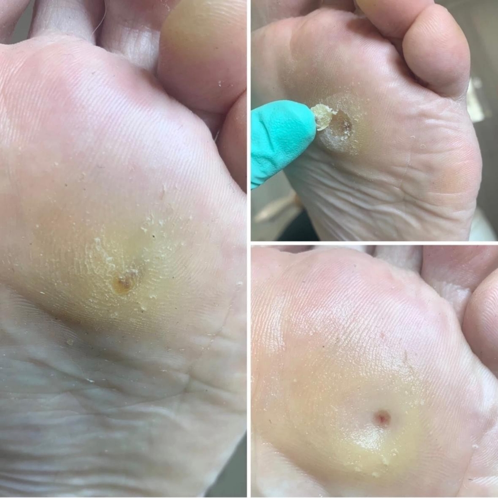 Обработка мозоли