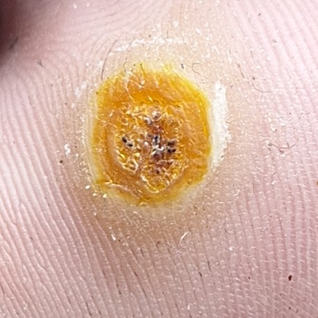 Обработка бородавки 1 ед.
первичное посещение