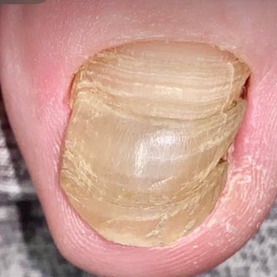 Обработка  1-го пальца стопы
(первичное посещение)
Онихолизис/онихомикоз/травма/утолщение с консультацией