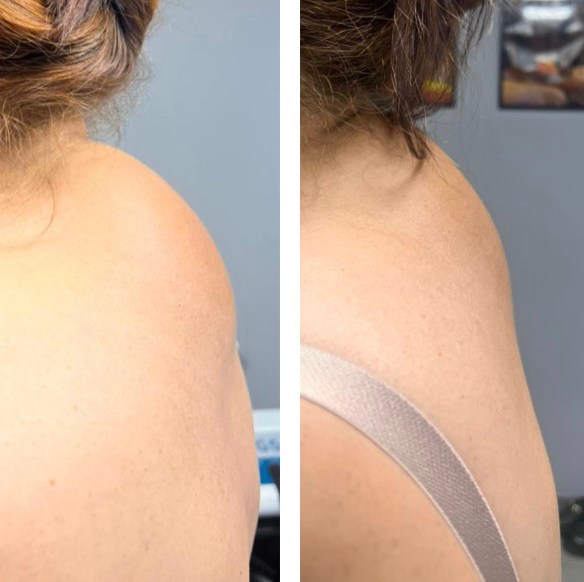 Криолиполиз холка ( 30 минут )+ турбо массаж (10 минут )