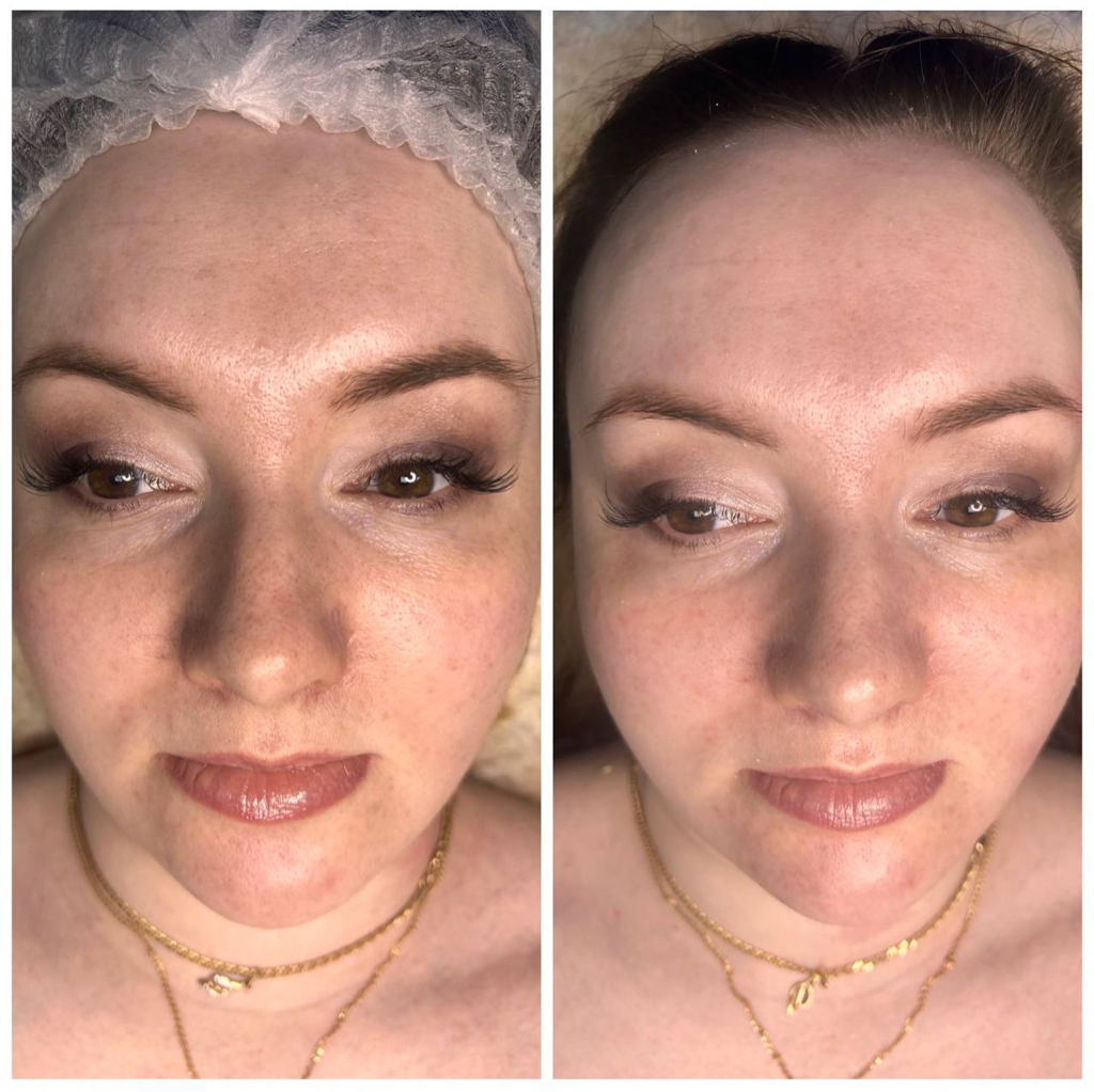 Карбокситерапия