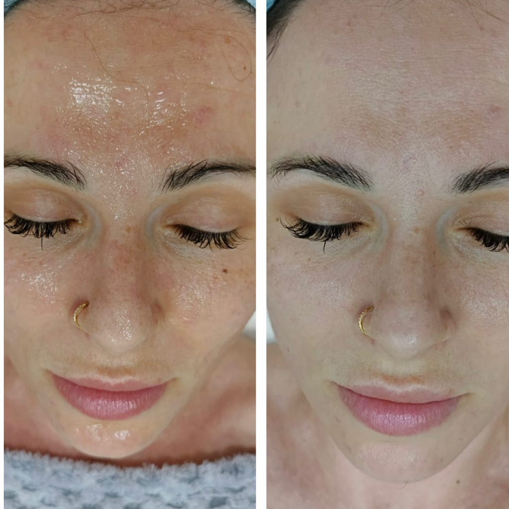 Химический пилинг: молочный, миндальный, желтый