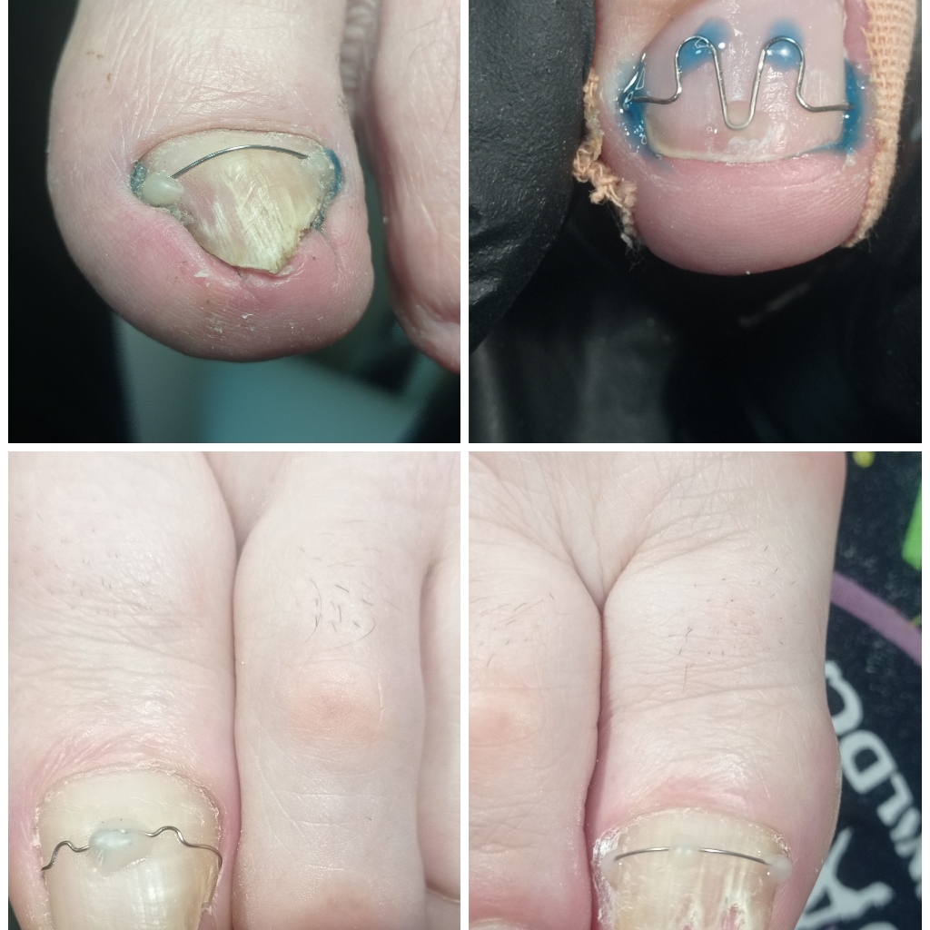 Коррекция любой коррекционной системы