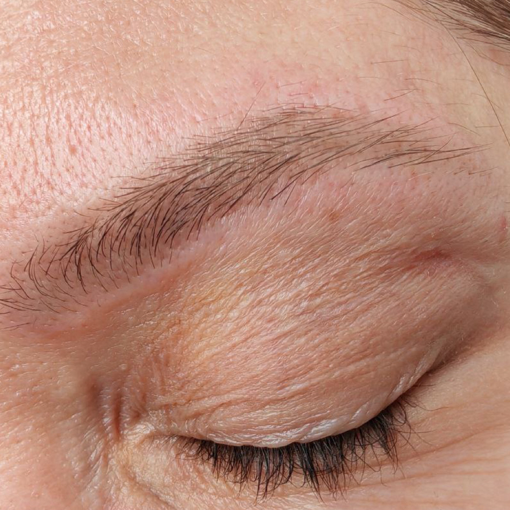 Удаление татуажа лазером (брови/губы) первичное посещение