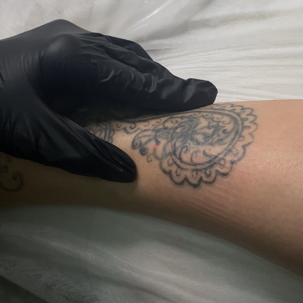 Удаление татуировок лазером