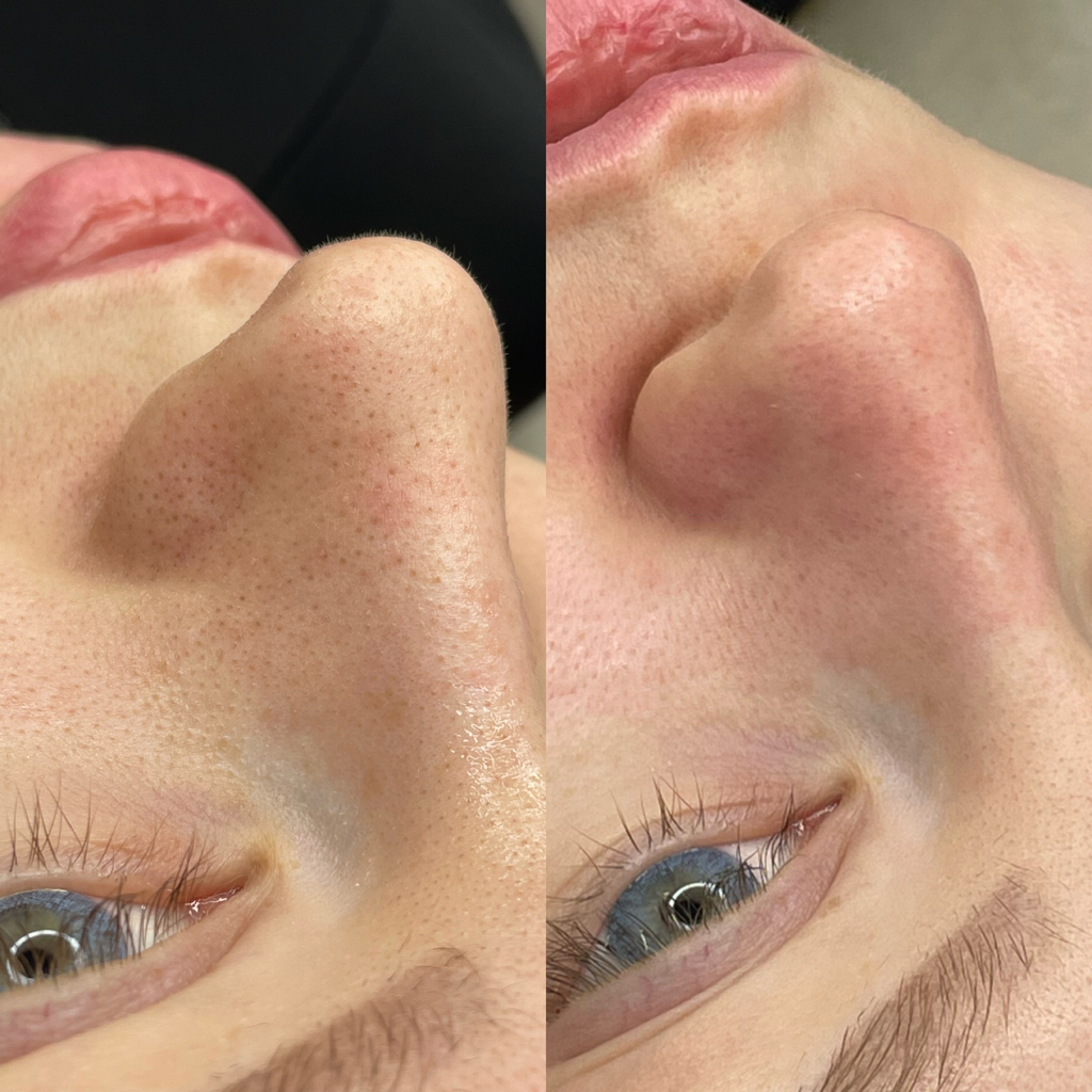 Ультразвуковая чистка + пилинг MEDIDERMA