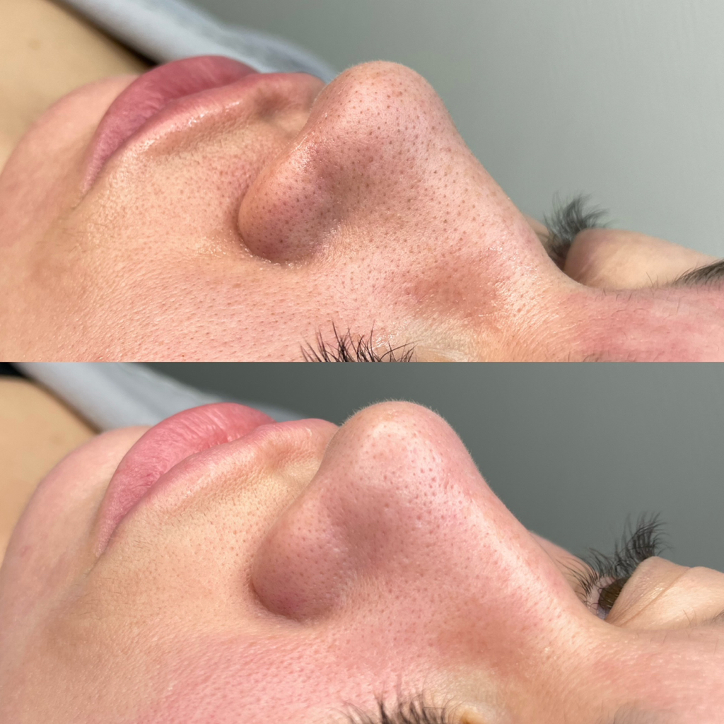 Механическая чистка + пилинг MEDIDERMA