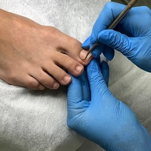 Комплекс 8. Снятие, педикюр (пальчики)