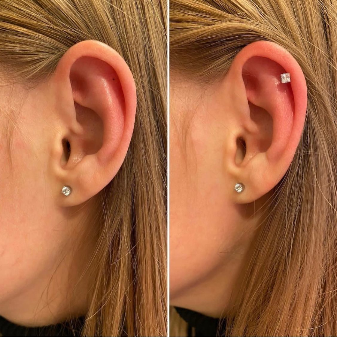 Прокол двух мочек