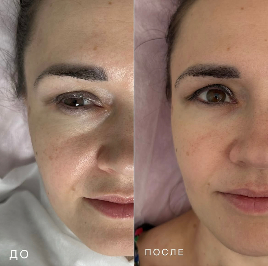 Контурная пластика