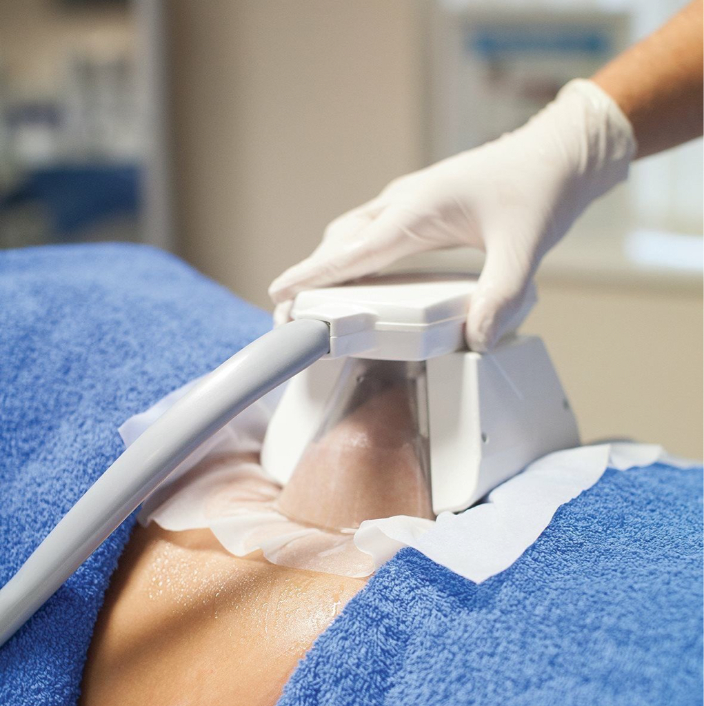 Криолиполиз 1 манипуляция