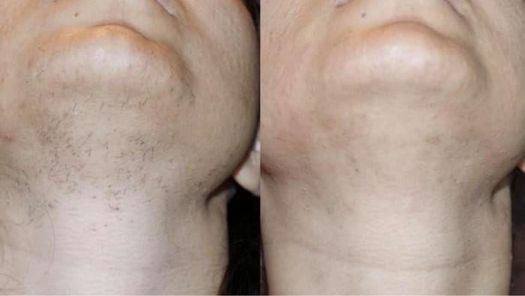 Подбородок шугаринг