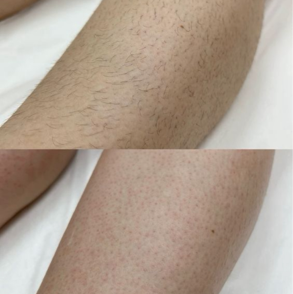 Ноги полностью шугаринг