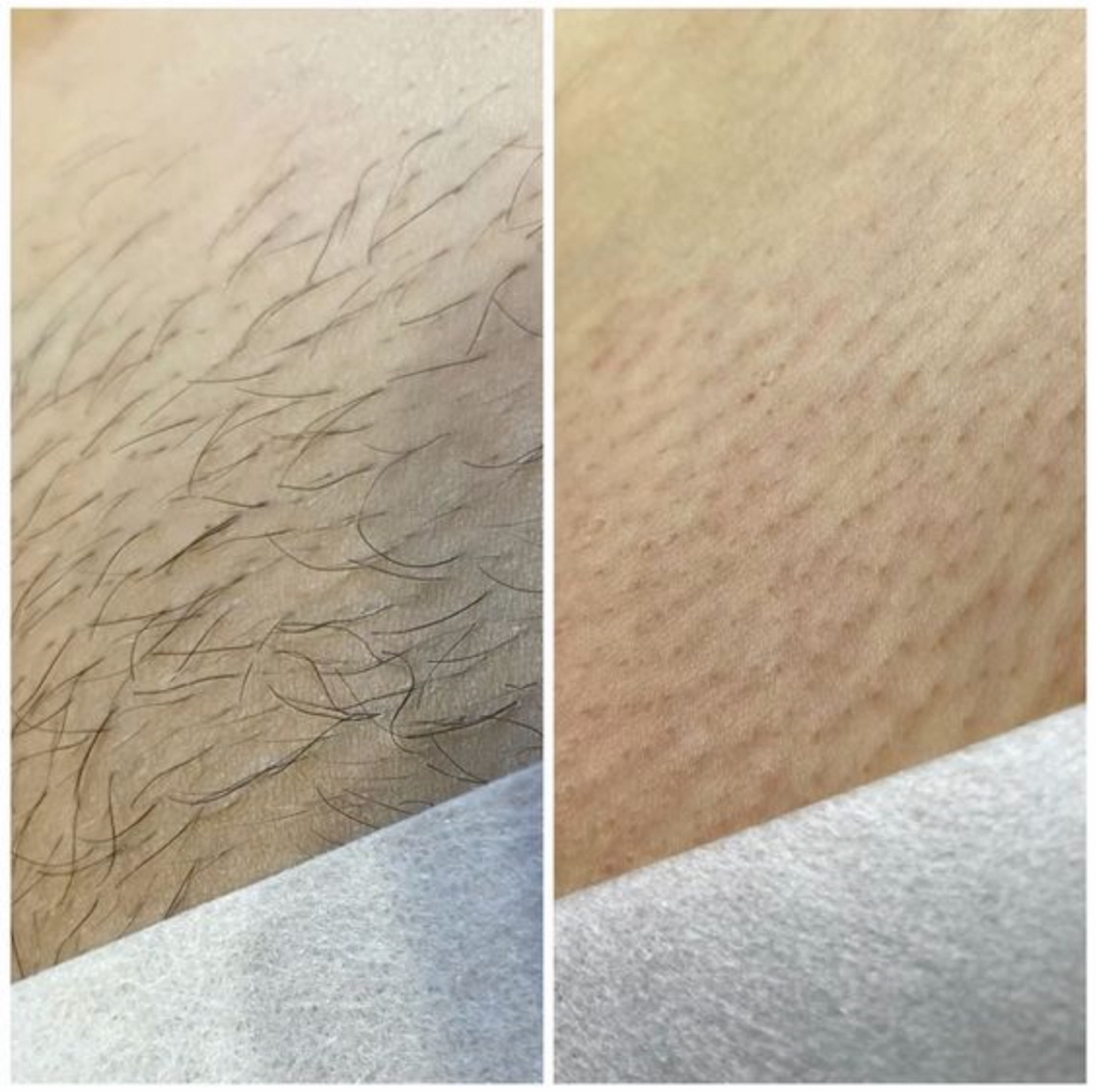 Бикини глубокое шугаринг