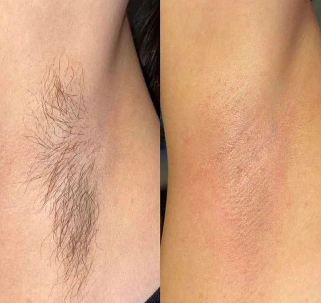 Подмышечные впадины шугаринг