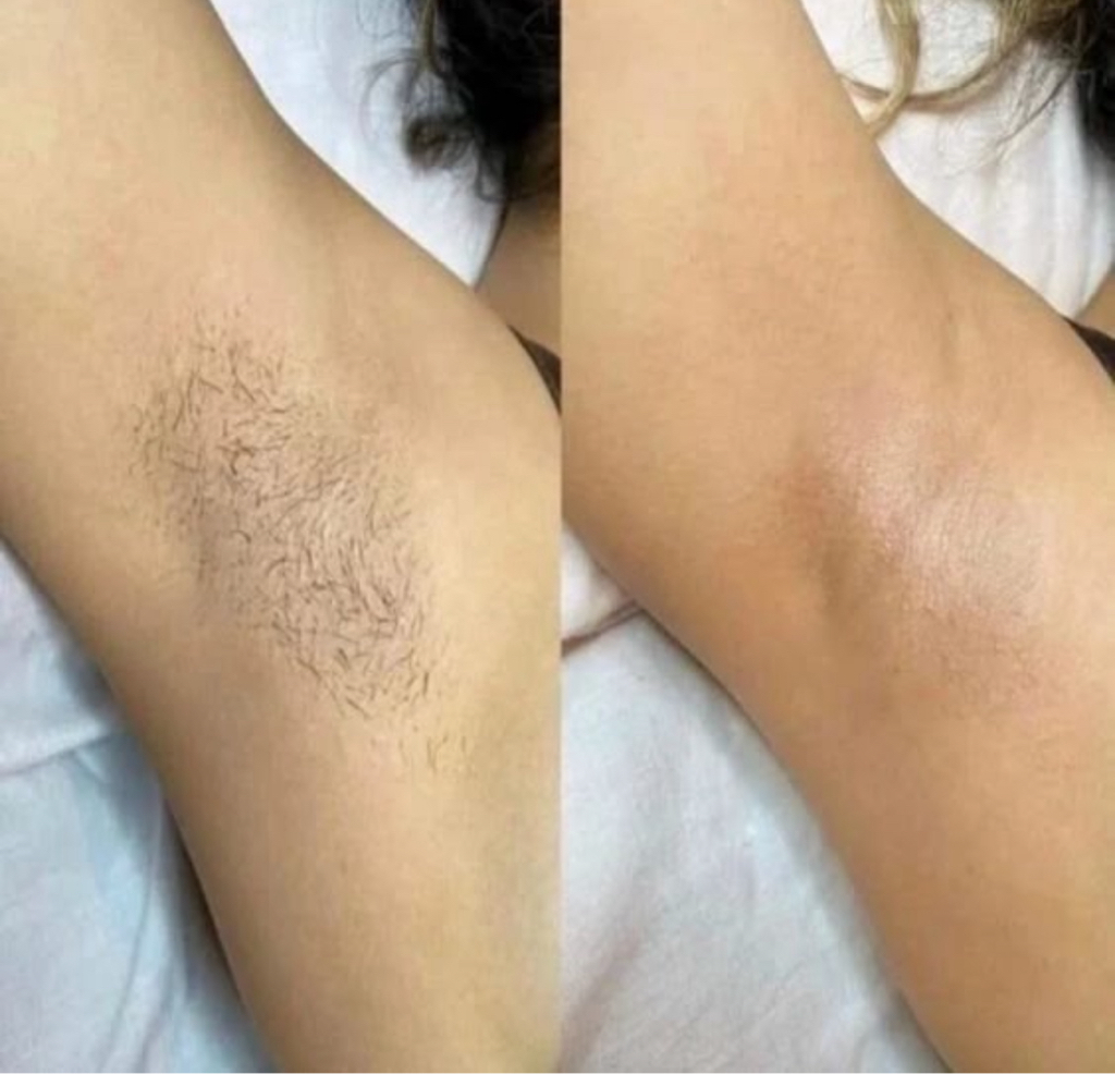 Легкий комплекс эпиляция подмышки/глубокое бикини