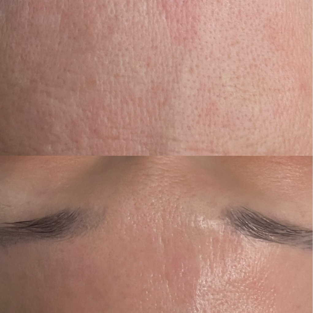 Элос-омоложение лицо + шея