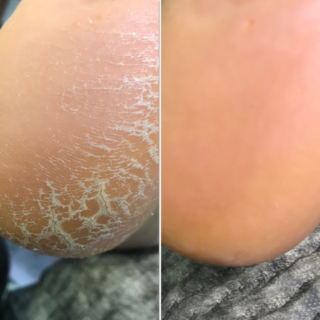 Обработка стопы Golden Trace / дисковой системой