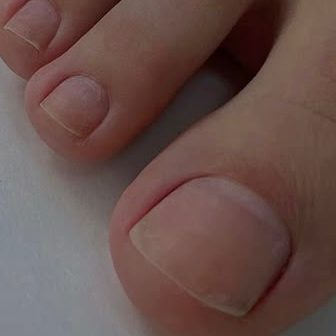 Удаление вросшего ногтя с обработкой.