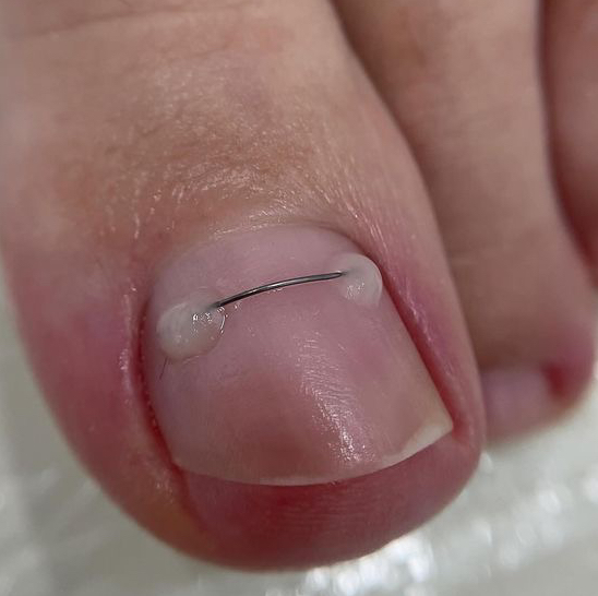 Коррекция титановой нити 1 стад.