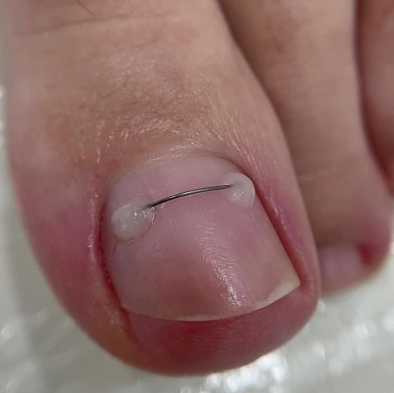 Установка титановой нити 2 ст