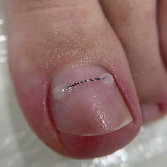 Установка титановой нити 1ст