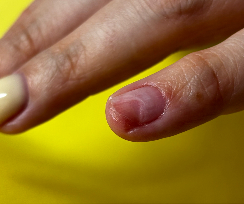 Зачистка онизолизиса